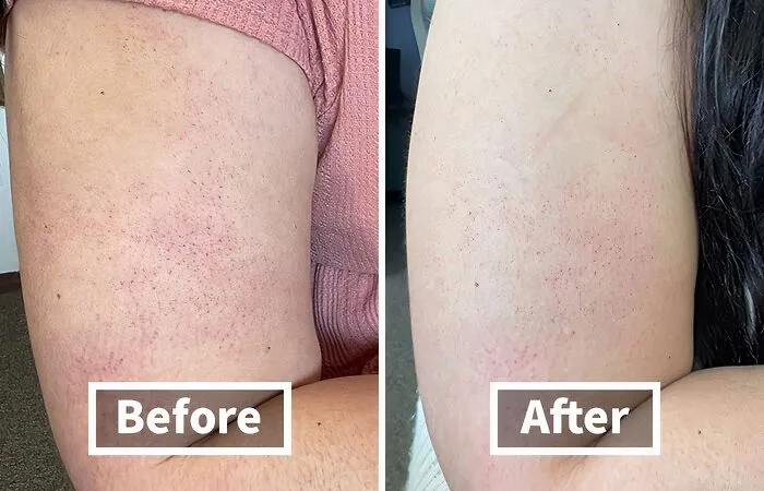<a style="display:inline;" href="https://www.amazon.com/First-Aid-Beauty-Exfoliant-Keratosis/dp/B08GNS58PQ?ie=UTF8&linkCode=ll1&tag=bpgorilla-20&linkId=b01625c0c4141d0006f751b107a5c34d&language=en_US&ref_=as_li_ss_tl " target="_blank"> If Your Arms Are Feeling Bumpier That The Surface Of The Moon, Try This <span Style="Font:inherit;color:#d74b1f;"> KP Removing Scrub </Span> That Users Swear By