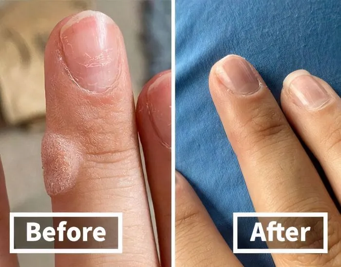 If You Have Been Playing With Too Many Frogs, Try This<span Style="Font:inherit;color:#d74b1f;">  Compound W Wart Remover  </Span> To Get Your Hands Back To Looking Like Those Of A Princess