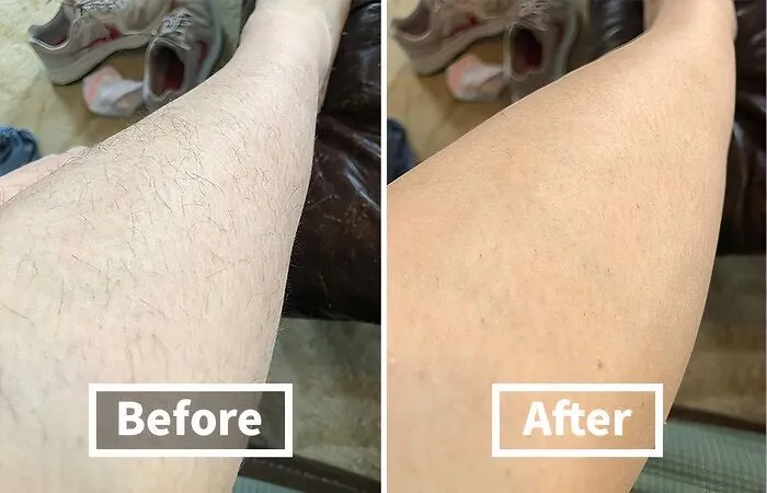 Go From Sasquatch To Summer Ready With This <span Style="Font:inherit;color:#d74b1f;"> Hair Epilator </Span> That Is Hairy Girl Approved
