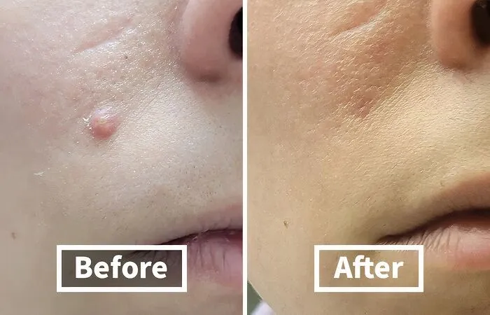 Zap Your Zits With These<span Style="Font:inherit;color:#d74b1f;"> Award-Winning Pimple Patches </Span> From Hero Cosmetics