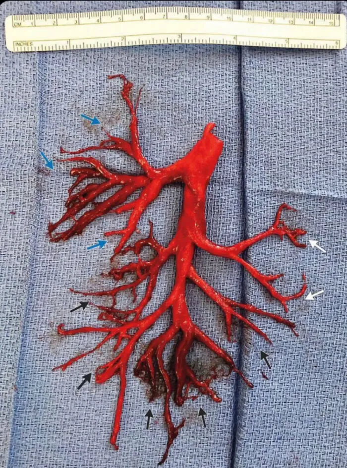 Un coágulo de sangre desprendido por un paciente forma perfectamente la cavidad pulmonar que ocupaba