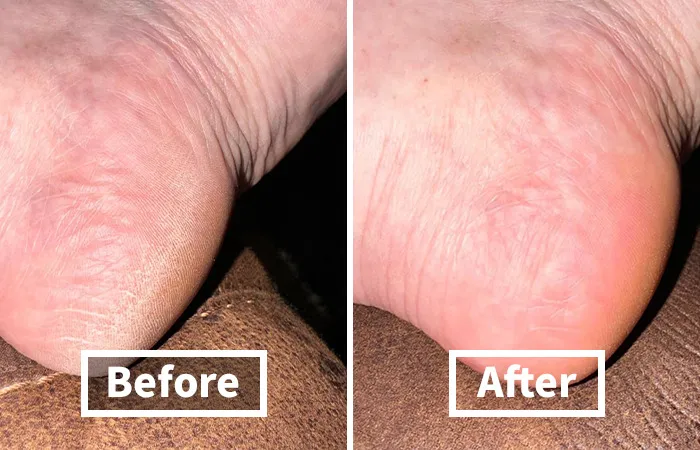 If Your Feet Are Looking A Bit Pre-Historic, Try This <span Style="Font:inherit;color:#d74b1f;"> Instant Foot Peeling Spray </Span> To Get Them Baby Soft Again