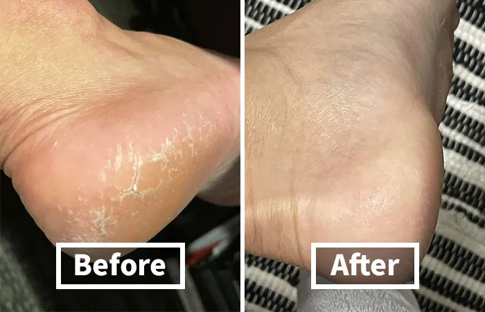 Is Traveling Having Your Pedi Looking Less Than Perfect? Try This <span Style="Font:inherit;color:#d74b1f;"> Cracked Heel Repair Balm </Span>