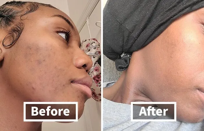 <span Style="Font: Inherit; Color: #d74b1f;"> Panoxyl Acne Foaming Wash</Span>: Banish Breakouts, Boost Confidence! 