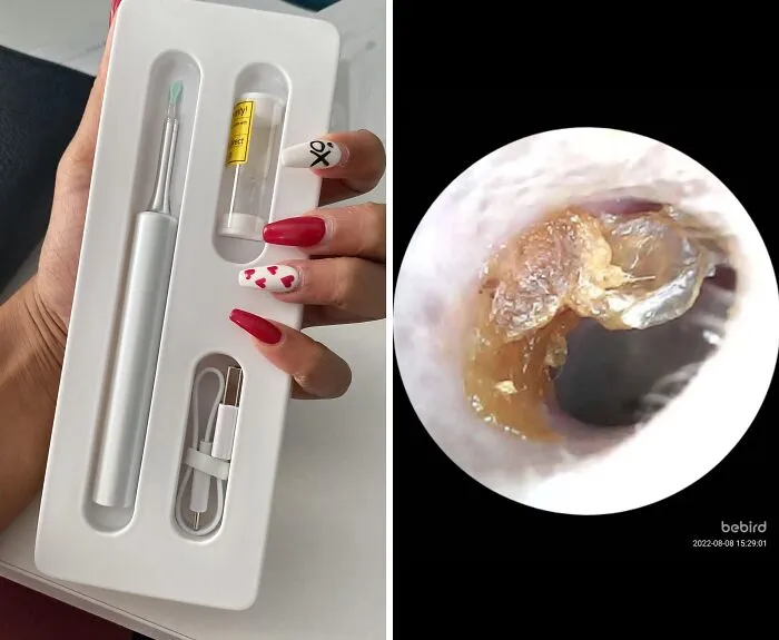 An <span Style="Font: Inherit; Color: #d74b1f;"> Ear Wax Removal Endoscope Otoscope</Span> Is A Whole New Level For Dr. Pimple Popper Obsessed People