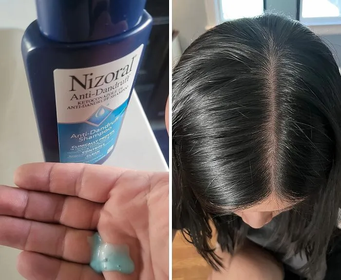 <span Style="Font: Inherit; Color: #d74b1f;"> Nizoral Anti-Dandruff Shampoo</Span>: The Itch-Free, Flake-Free Solution Your Scalp Deserve