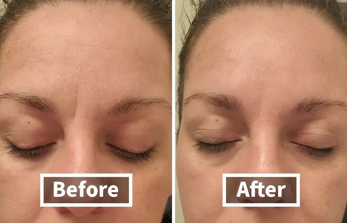 Botox? Nah, Just Stick It To Wrinkles With These <span Style="Font: Inherit; Color: #d74b1f;"> Forehead & Between The Eyes Wrinkle Patches</Span>
