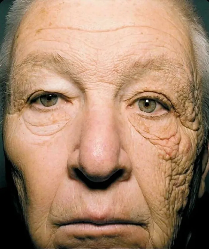 A Photo Published In The New England Journal Of Medicine Shows A Delivery Truck Driver's Severe Sun Damage On His Left Side After 28 Years Of Uva Exposure Through His Window