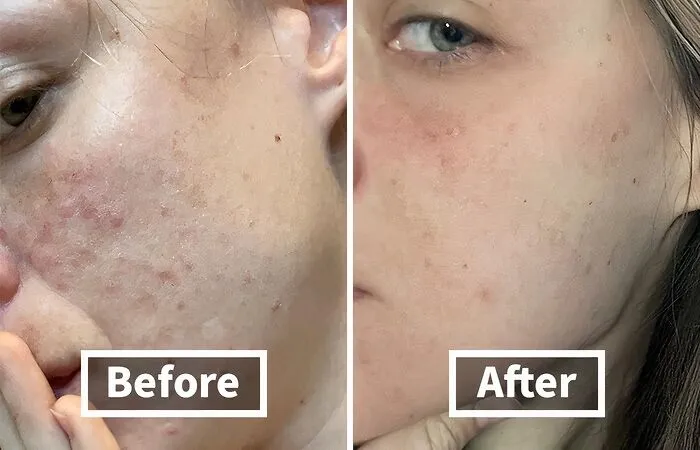 You Will Clearly Be Able To Spot The Difference After Using This <span Style="Font: Inherit; Color: #d74b1f;"> Anti-Acne Soap</Span>