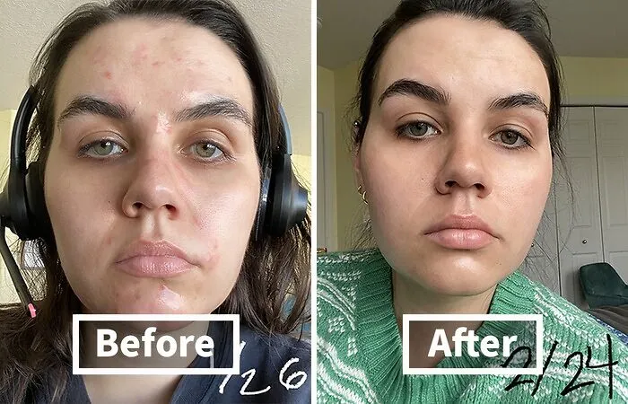 Break Up With Breakouts With This Viral <span Style="Font: Inherit; Color: #d74b1f;"> Facial Cleanser</Span>