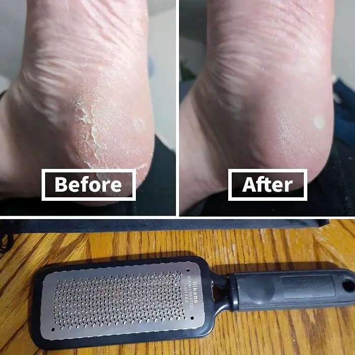 Kick Your Old-School Pumice Stone To The Curb And Upgrade To The <a Style="Display:inline;" Href="Https://Www.amazon.com/Dp/B00vpvevsk?ascsubtag=7339015%2c21%2c48%2cd%2c0%2c0%2c0%2c900%3a2%3b974%3a3%3b1125%3a1%3b1242%3a1%2c19179937%2c0%2c0%2c0&btn_ref=srctok-Ef00aec0414b8b84&linkcode=ll1&tag=bpdonkey-20&linkid=7afee6c37793eaf5cf971543566a8d70&language=en_us&ref_=as_li_ss_tl" Target="_blank"><span Style="Font: Inherit; Color: #d74b1f;"> Colossal Foot Rasp</Span>