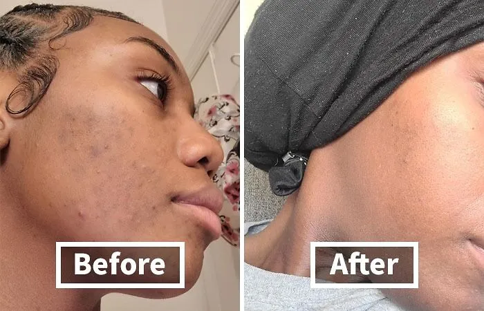 Zits And Oil? No More! This <span Style="Font: Inherit; Color: #d74b1f;"> Panoxyl Acne Foaming Wash</Span> Is Your Skin's Superhero