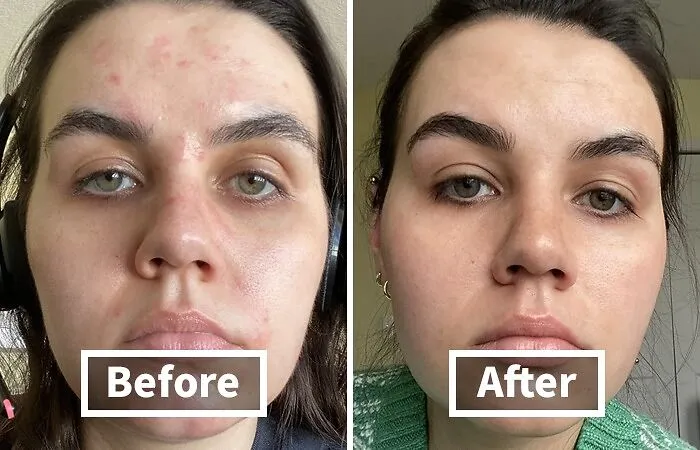  <a Style="Display:inline;" Href="Https://Www.amazon.com/Skinsmart-Cleanser-Bacteria-Athletes-Multiple/Dp/B07vrfc3y7?ie=utf8&linkcode=ll1&tag=bpfox-20&linkid=b9012fc14bb2b03c45c4988ca8383699&language=en_us&ref_=as_li_ss_tl" Target="_blank"><span Style="Font: Inherit; Color: #d74b1f;"> Skinsmart Facial Cleanser For Acne</Span>: The Breakthrough Cleanser That's Winning The War Against Breakouts