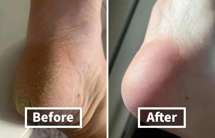 The Only Way To Get Sandal Ready Is With This <span Style="Font:inherit;color:#d74b1f;"> Colossal Foot Rasp Foot File</Span>