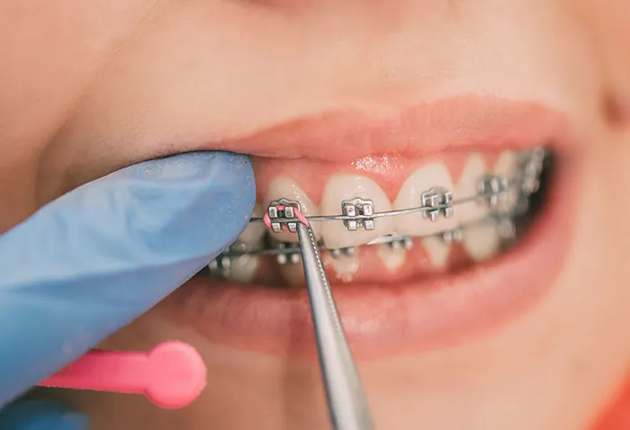 Braces