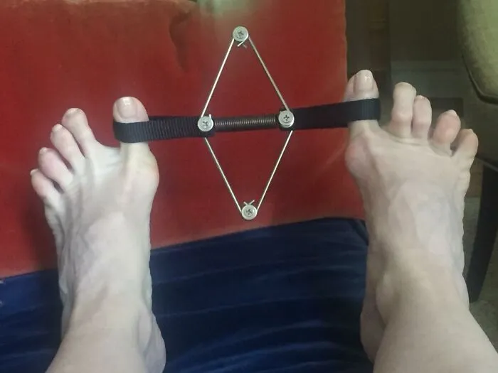 This <a Style="Display:inline;" Href="Https://Www.amazon.com/Bunion-Corrector-Toe-Straightener-Overlapping/Dp/B073gtzccr?ie=utf8&linkcode=ll1&tag=bparmadillo-20&linkid=ccd076ad88dca26170fc284c140bbcba&language=en_us&ref_=as_li_ss_tl"_blank"><span Style="Font: Inherit; Color: #d74b1f;"> Bunion Corrector</Span> Is The Non-Surgical Solution Your Feet Have Been Craving – Say Goodbye To Painful Bunions And Hello To Comfortable Shoes