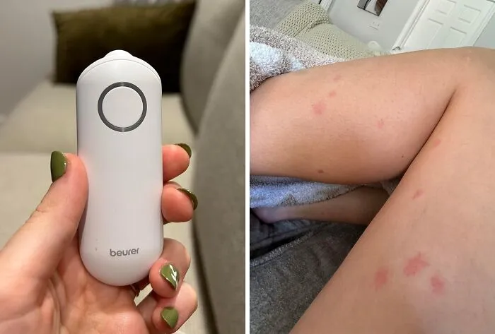 <a Style="Display:inline;" Href="Https://Www.amazon.com/Beurer-Br60-Chemical-Free-Treatment-Non-Toxic/Dp/B08mt4z89c?ie=utf8&linkcode=ll1&tag=bpstarfish-20&linkid=e5886e82fb177e876025726fcac12b79&language=en_us&ref_=as_li_ss_tl" Target="_blank"><span Style="Font: Inherit; Color: #d74b1f;"> Bug Bite Thing Suction Tool</Span>: Don't Scratch That Itch, Just Suck It Up!