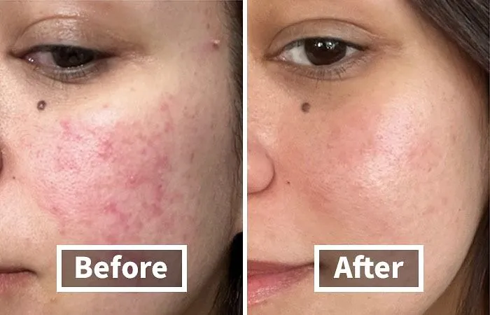 From "Blah" To "Ahhh," Unveil Your Skin's Natural Radiance With  <a Style="Display:inline;" Href="Https://Www.amazon.com/Roche-Posay-Toleriane-Hydrating-Gentle-Cleanser/Dp/B01n7t7jkj?psc=1&linkcode=ll1&tag=bpwombat-20&linkid=bc4f2a03781a73af066fbcf392c08332&language=en_us&ref_=as_li_ss_tl" Target="_blank"><span Style="Font: Inherit; Color: #d74b1f;"> La Roche-Posay Toleriane Hydrating Gentle Face Cleanser</Span>