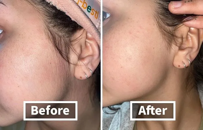  <a Style="Display:inline;" Href="Https://Www.amazon.com/Schick-Multipurpose-Exfoliating-Dermaplaning-Precision/Dp/B0787glbmv?psc=1&linkcode=ll1&tag=bpwombat-20&linkid=44ef470ab7fa154112aded0351fce766&language=en_us&ref_=as_li_ss_tl" Target="_blank"><span Style="Font: Inherit; Color: #d74b1f;"> Schick Hydro Silk Touch-Up Dermaplaning Tool</Span>: The Multi-Tasking Tool For Flawless Brows And Smooth Skin