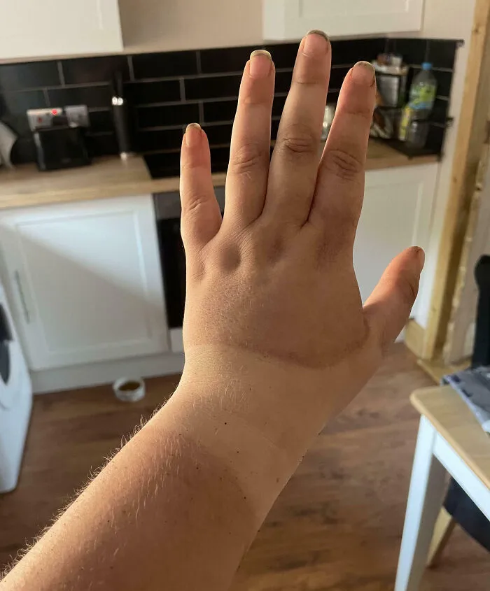 Spent Two Days In The Glorious Sunshine Working Outside And Did Not Anticipate Getting A Tan. Guess I’ll Keep The Thumb Splint On A Bit Longer