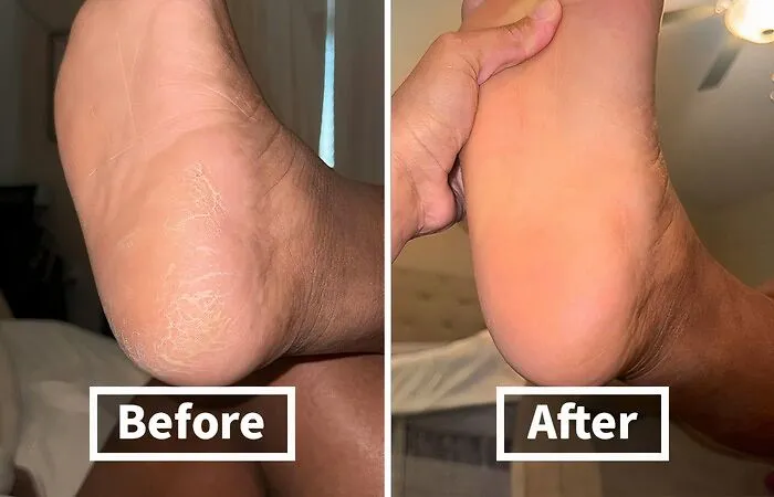 From Cracked Heels To Silky Smooth: <a Style="Display:inline;" Href="Https://Www.amazon.com/Dp/B01ncmjpoq?ascsubtag=7692517%2c6%2c25%2cd%2c0%2c0%2cbf-Web-Hf%2c900%3a2%3b974%3a3%3b1125%3a1%3b1242%3a1%2c47537077%2c0%2c0%2c0&btn_ref=srctok-C71755cbd4c7a8ba&linkcode=ll1&tag=bpfish-20&linkid=7085fd327cf059f368028178fe4d14f5&language=en_us&ref_=as_li_ss_tl" Target="_blank"><span Style="Font: Inherit; Color: #d74b1f;"> Callus Remover Gel</Span> Transforms Your Feet