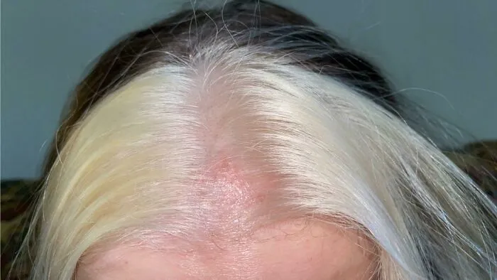 Mi peluquera, durante mi cita, tenía otro cliente y me dejó decolorante en el pelo durante más de una hora. Ahora tengo quemaduras químicas y no me da ningún consejo