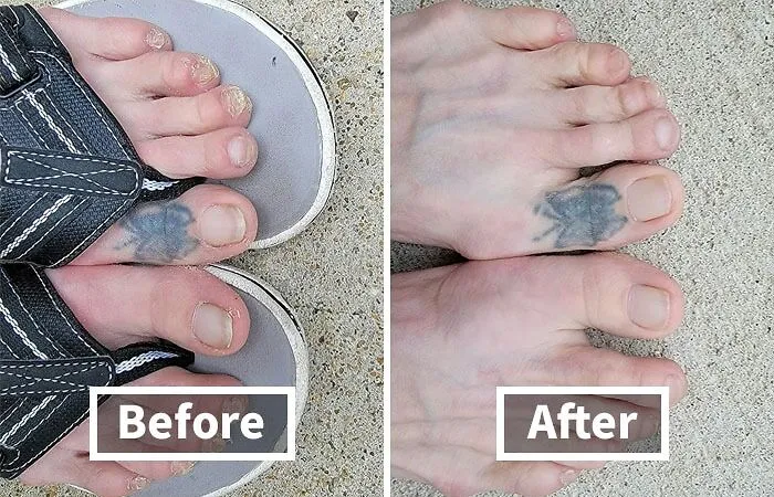 Say "So Long" To Brittle, Discolored Nails And "Hello" To Strong, Healthy Nails With This Clinically Proven <a Style="Display:inline;" Href=" Https://Www.amazon.com/Dp/B007adol28?ascsubtag=7674268%2c9%2c43%2cd%2c0%2c0%2c0%2c900%3a2%3b974%3a1%3b1125%3a2%3b1338%3a1%2c46430305%2c0%2c0%2c0&btn_ref=srctok-84d32dbeba65d760&linkcode=ll1&tag=bpbutterfly-20&linkid=00ec7c5ed32d0ecf278d4c429dd0dbef&language=en_us&ref_=as_li_ss_tl " Target="_blank"><span Style="Font: Inherit; Color: #d74b1f;"> Kerasal Nail Renewal</Span>