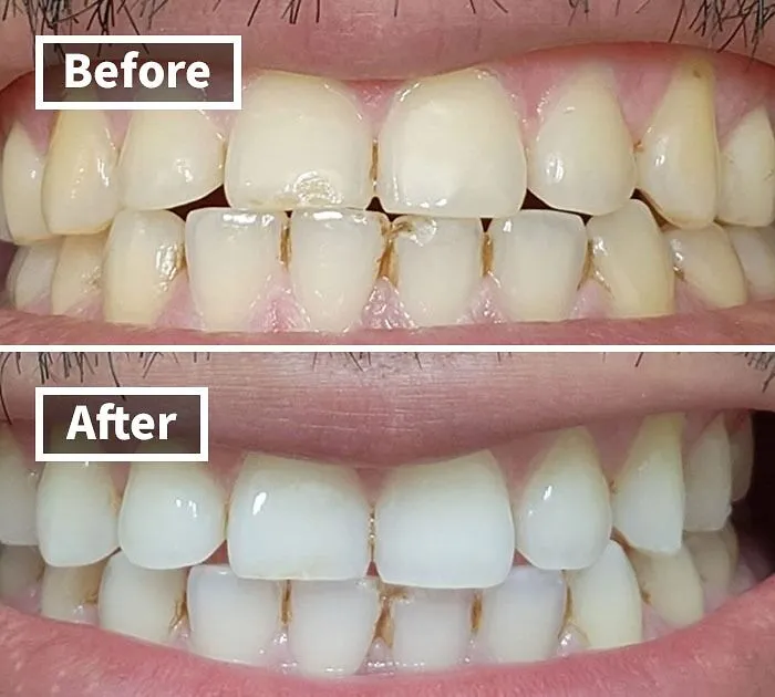Pandas Are Saying Goodbye To Yellow Teeth And Hello To A Brighter Smile With This Top-Rated <a Style="Display:inline;" Href="Https://Www.amazon.com/Crest-Professional-Whitestrips-Whitening-Treatments/Dp/B00ahawwo0?ie=utf8&linkcode=ll1&tag=bppeacock-20&linkid=17e36e099549a667243cc82cd90f80f7&language=en_us&ref_=as_li_ss_tl" Target="_blank"><span Style="Font: Inherit; Color: #d74b1f;"> Whitestrips Kit</Span>