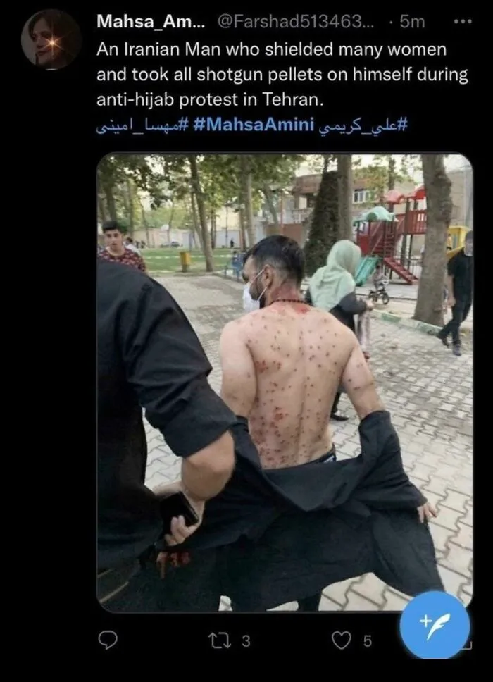 Man Took Bullets From A Shotgun In Iran