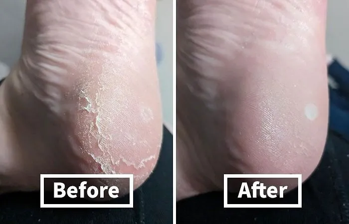 This <a Style="Display:inline;" Href="Https://Www.amazon.com/Colossal-Remover-Pedicure-Surgical-Stainless/Dp/B00vpvevsk?ie=utf8&linkcode=ll1&tag=bparmadillo-20&linkid=e6d4a1301e6ddd0b7d852b21319d0bc0&language=en_us&ref_=as_li_ss_tl"_blank"><span Style="Font: Inherit; Color: #d74b1f;"> Colossal Foot Rasp</Span> Is The Must-Have Tool For Anyone Who Wants To Achieve Sandal-Ready Feet In The Comfort Of Their Own Home