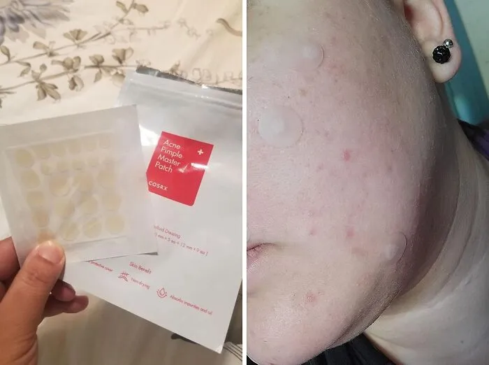 Whether You're Dealing With A Sudden Breakout Or A Stubborn Pimple, These <a Style="Display:inline;" Href=" Https://Www.amazon.com/COSRX-Absorbing-Hydrocolloid-Treatment-Healing/Dp/B014sab948?th=1&psc=1&linkcode=ll1&tag=bpturtle-20&linkid=4af7aa02d8fb4c582d8a530c769b1cd8&language=en_us&ref_=as_li_ss_tl" Target="_blank"><span Style="Font: Inherit; Color: #d74b1f;"> COSRX Pimple Patches</Span> Are The Gentle Yet Effective Solution Your Skin Needs