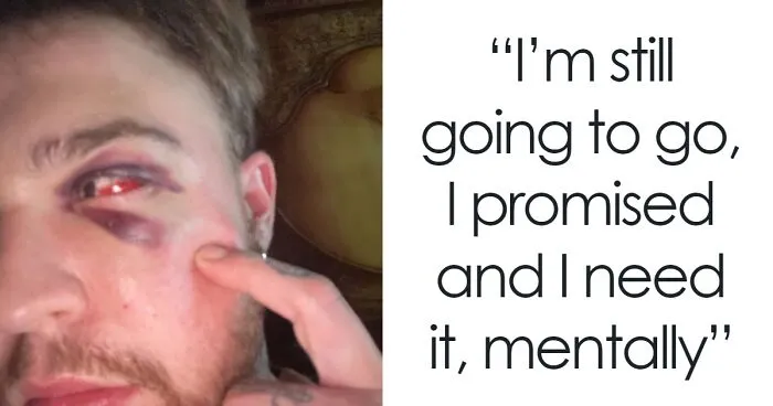 29-Year-Old Trans Man Gets Brutally Beaten Up In Switzerland, Claims It’s A Hate Crime