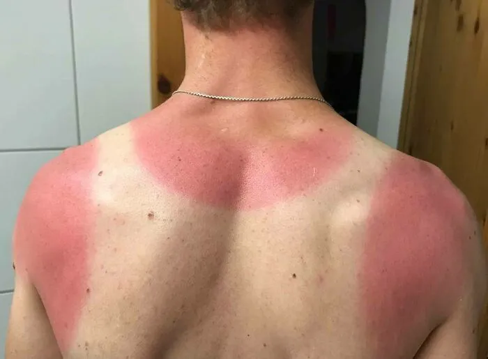Se me olvidó ponerme protector