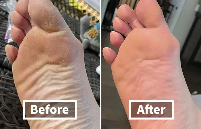 This <a Style="Display:inline;" Href="Https://Www.amazon.com/Tree-Foot-Soak-Epsom-Salt/Dp/B076l558r3?ie=utf8&linkcode=ll1&tag=bparmadillo-20&linkid=5488b1824127b1b7b70ecf572676a003&language=en_us&ref_=as_li_ss_tl"_blank"><span Style="Font: Inherit; Color: #d74b1f;"> Tea Tree Oil Foot Soak</Span> Is The At-Home Spa Treatment Your Tired Feet Deserve, Transforming Them From Overworked To Oh-So-Smooth