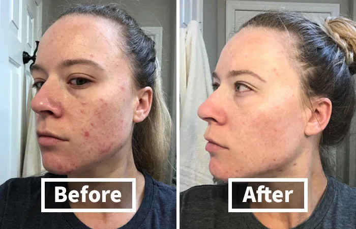 Combat The Signs Of Aging With The Powerful Antioxidant Blend In  <a Style="Display:inline;" Href="Https://Www.amazon.com/Truskin-Naturals-Vitamin-Topical-Hyaluronic/Dp/B01m4mcuaf?psc=1&linkcode=ll1&tag=bpwombat-20&linkid=41dd54aef771fe3bca2617f5ce993be3&language=en_us&ref_=as_li_ss_tl" Target="_blank"><span Style="Font: Inherit; Color: #d74b1f;"> Truskin Vitamin C Face Serum</Span>