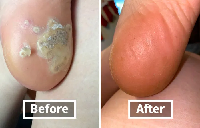 This <a Style="Display:inline;" Href="Https://Www.amazon.com/Dp/B08pdpt77c?ascsubtag=7635565%2c15%2c28%2cd%2c0%2c0%2c0%2c900%3a2%3b974%3a3%3b1125%3a2%3b1338%3a1%2c44932350%2c0%2c0&ie=utf8%25252c0%252c0%2c0&btn_ref=srctok-Af4210ade1b185b5&th=1&linkcode=ll1&tag=bparmadillo-20&linkid=67f562afe0e8b031273c894d1e075b4b&language=en_us&ref_=as_li_ss_tl"_blank"><span Style="Font: Inherit; Color: #d74b1f;"> Compound W Wart Remover</Span> Is The Little Bottle Of Magic That Will Make Those Pesky Warts Disappear, So You Can Get Back To Showing Off Your Feet In Sandals Without Worry