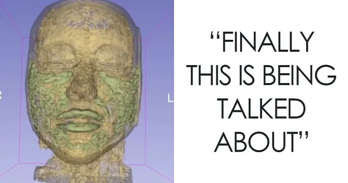 MRI Of 33-Year-Old Woman’s Face Reveals Where All Her Filler Went