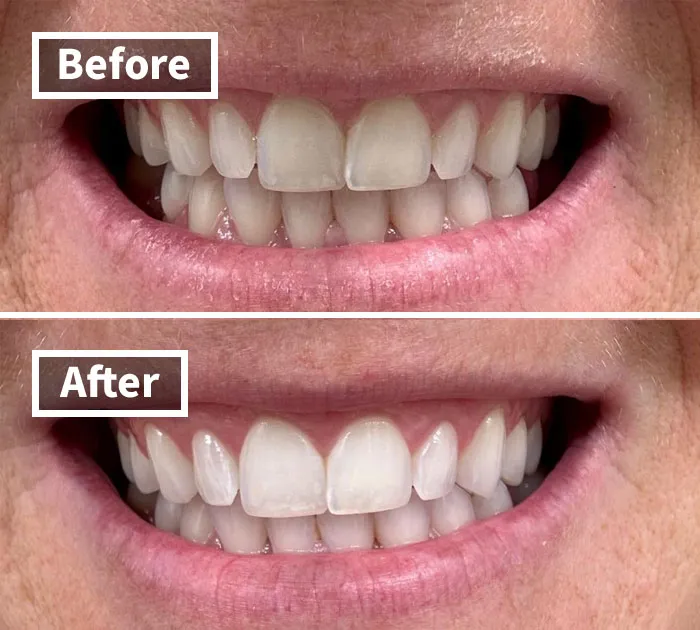 <a Style="Display:inline;" Href="Https://Www.amazon.com/Crest-Professional-Whitestrips-Whitening-Treatments/Dp/B00ahawwo0?_encoding=utf8&pf_rd_m=atvpdkikx0der&pf_rd_s=merchandised-Search-6&pf_rd_r=0msk3sf9yns6pq4aw8cx&pf_rd_p=9c229eab-23fe-4129-97eb-Ff55ca0009a2&pf_rd_t=&pf_rd_i=121539624011&linkcode=ll1&tag=bpworm-20&linkid=40724a68b199423e398b6119e1b87ba1&language=en_us&ref_=as_li_ss_tl" Target="_blank"><span Style="Font: Inherit; Color: #d74b1f;"> Crest 3D Whitestrips Professional Effects</Span>: Reveal Your Brightest Smile This Prime Day!