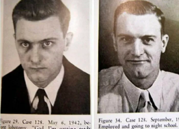 Imagen de un hombre con esquizofrenia antes y después de su lobotomía