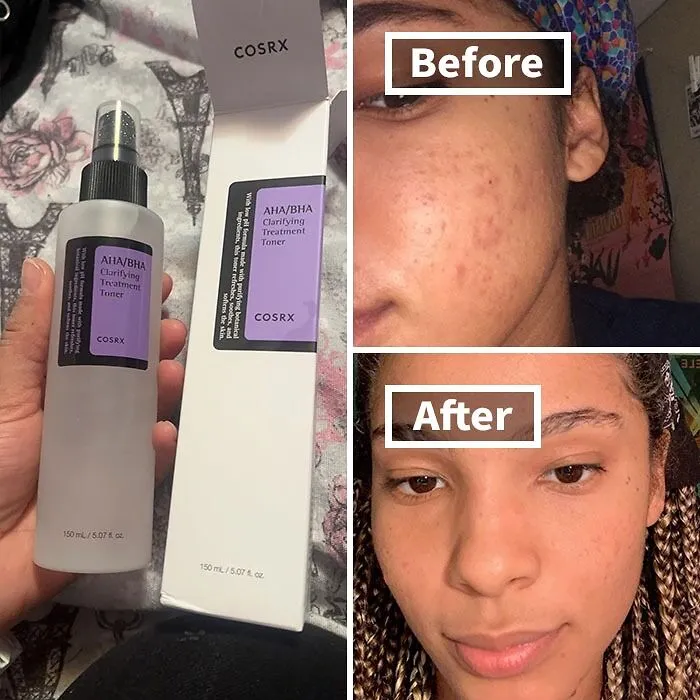 This <a Style="Display:inline;" Href=" Https://Www.amazon.com/COSRX-Clarifying-Treatment-Toner-150ml/Dp/B073p6bpf5?th=1&psc=1&linkcode=ll1&tag=bpturtle-20&linkid=560c3bbddca10e1a3d5711bdf8e95098&language=en_us&ref_=as_li_ss_tl" Target="_blank"><span Style="Font: Inherit; Color: #d74b1f;"> COSRX Aha/Bha Clarifying Treatment Toner</Span> Is The One-Step Solution For Achieving A Healthy, Balanced Glow – It Gently Exfoliates And Refines Your Pores With A Refreshing Mist