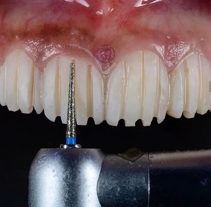 Close-up of dental drill and textured teeth, creating an oddly terrifying image.