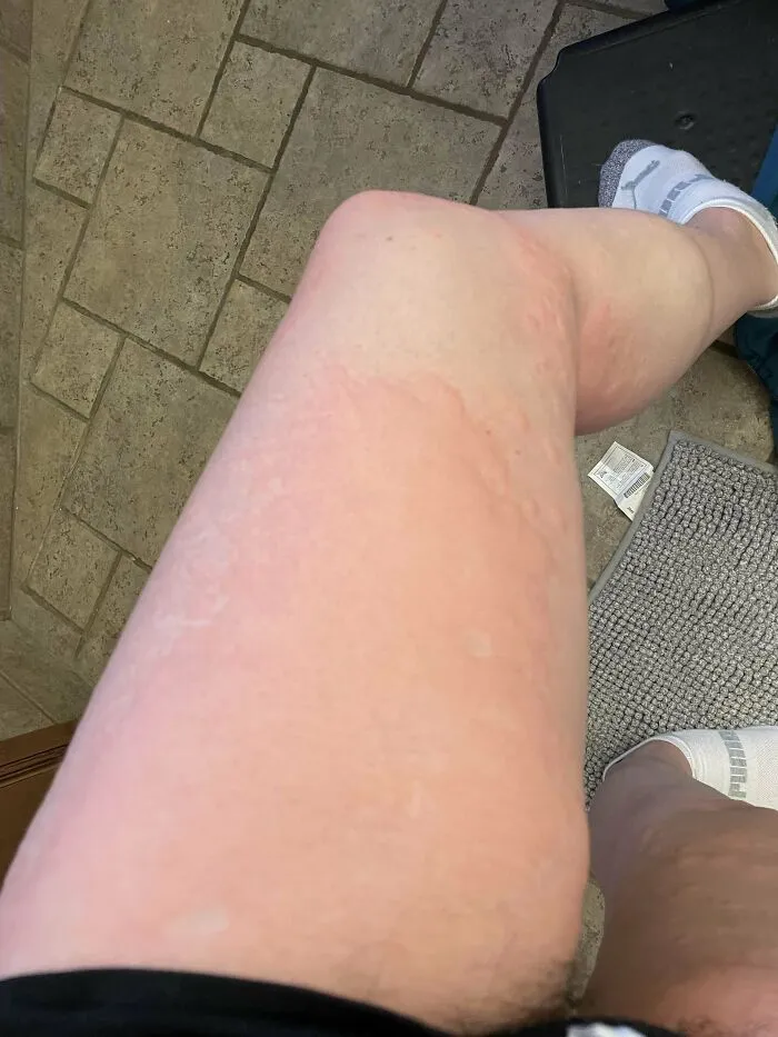 Ever Since I Got Covid Twice Working As A Hcp In 2020, I Now Get Full Body Hives, Apparently A Post-Viral Reaction, A Couple Times A Month, Mostly When I’m Stressed