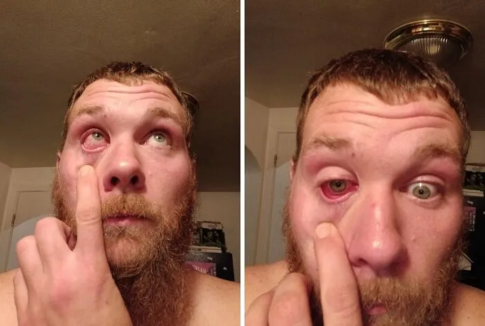 "Got bleach in my eye" - <span Style="Font:inherit;color:#808080"> Chef_Josh_420</Span>