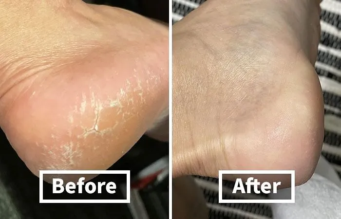 Cracked Heels Got You Feeling Like The Sahara Desert? <a Style="Display:inline;" Href="Https://Www.amazon.com/Dr-Scholls-Cracked-Moisturizes-Healthy/Dp/B08yzbbvgk?ie=utf8&linkcode=ll1&tag=bpdolphin-20&linkid=f1ee9cd12aa046d447f9637860d2e145&language=en_us&ref_=as_li_ss_tl"_blank"><span Style="Font: Inherit; Color: #d74b1f;"> Dr. Scholl's Severe Cracked Heel Repair Balm</Span> Is Your Oasis Of Hydration, Bringing Those Rough Patches Back To Life