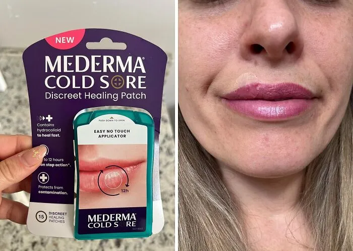  <a Style="Display:inline;" Href="Https://Www.amazon.com/Mederma-Cold-Discreet-Healing-Patch/Dp/B08mvf9yw1?ie=utf8&linkcode=ll1&tag=bpdolphin-20&linkid=35b7a61cb9cb5cc91bbcb91137159ae2&language=en_us&ref_=as_li_ss_tl"_blank"><span Style="Font: Inherit; Color: #d74b1f;"> Mederma Fever Blister Discreet Healing Patch</Span> Is Like A Tiny Invisibility Cloak For Those Pesky Cold Sores, Helping You Feel Confident And Comfortable While They Heal