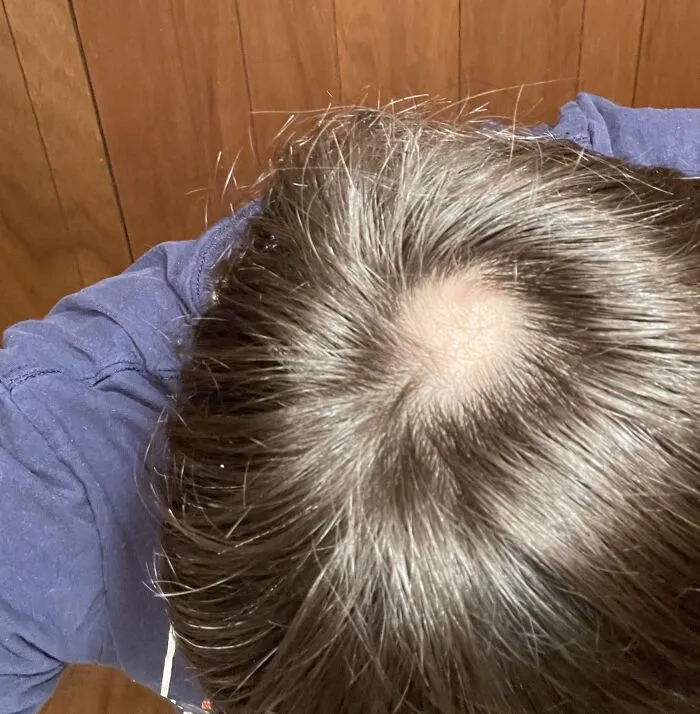 "Took off my headphones tonight and noticed I have a balled spot" - <span Style="Font:inherit;color:#808080"> saltless-fries</Span>
