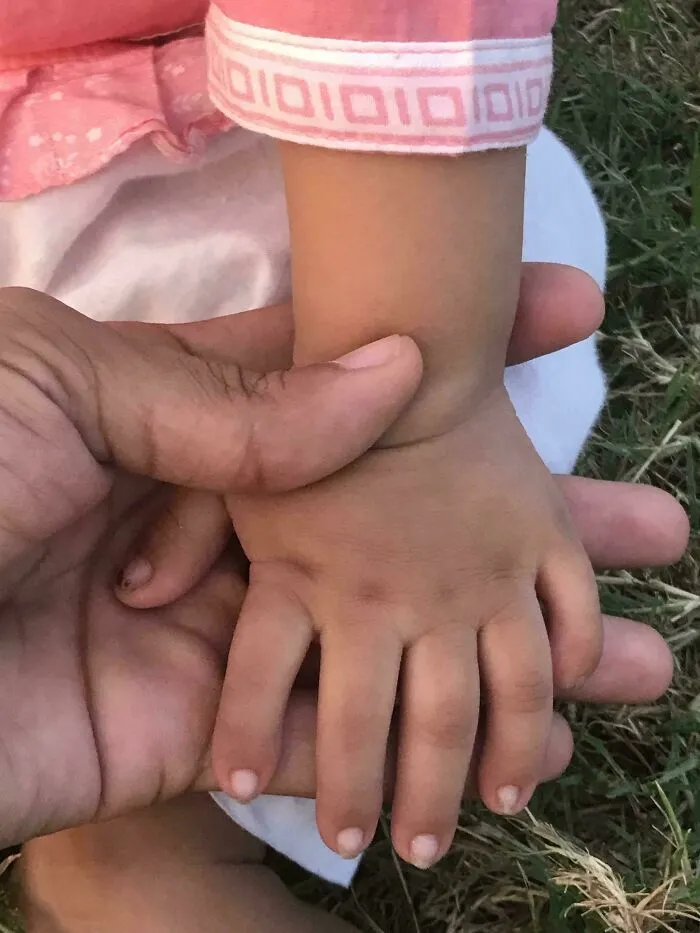 Mi sobrina tiene 6 dedos en ambas manos