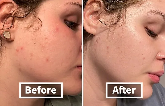 Before: Dull, Tired Skin Showing The Wear And Tear Of Daily Life <br><br> After: This Dynamic Duo Of <a Style="Display:inline;" Href="Https://Www.amazon.com/Dp/B014pgeeo2?ascsubtag=7700644%2c8%2c31%2cd%2c0%2c0%2cbf-Web-Hf%2c900%3a2%3b974%3a3%3b1125%3a1%3b1338%3a1%2c48135597%2c0%2c0%2c0&btn_ref=srctok-9d548dfcdc7ec43f&linkcode=ll1&tag=bpbobcat-20&linkid=aa4b0523d5ac43c8a5fd33467a42f901&language=en_us&ref_=as_li_ss_tl" Target="_blank"><span Style="Font: Inherit; Color: #d74b1f;"> Tree Of Life Face Serums</Span> Works Its Magic, Revealing A Brighter, Firmer, And More Hydrated Complexion That Radiates Youthful Energy