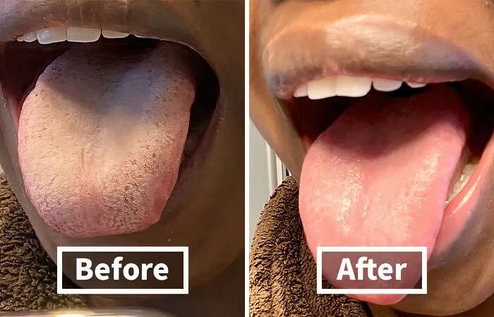 Before: Morning Breath That Could Knock Over A Dragon <br><br> After: A <a Style="Display:inline;" Href="Https://Www.amazon.com/Dp/B07vtrgstq?ascsubtag=7700644%2c14%2c31%2cd%2c0%2c0%2cbf-Web-Hf%2c900%3a2%3b974%3a3%3b1125%3a1%3b1338%3a1%2c0%2c0%2c0%2c0&btn_ref=srctok-97782d58828af911&linkcode=ll1&tag=bpbobcat-20&linkid=bd4d27ba36d2356b6505c46903803f4c&language=en_us&ref_=as_li_ss_tl" Target="_blank"><span Style="Font: Inherit; Color: #d74b1f;"> Metal Tongue Scraper</Span> Leaves Your Tongue Feeling (And Smelling) Fresh As A Daisy