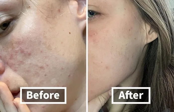 Before: Breakouts That Are Harsher Than A Reality TV Show Elimination <br><br> After:  <a Style="Display:inline;" Href="Https://Www.amazon.com/Dp/B014hyi86m?ascsubtag=7700644%2c18%2c31%2cd%2c0%2c0%2cbf-Web-Hf%2c900%3a2%3b974%3a3%3b1125%3a1%3b1338%3a1%2c48144905%2c0%2c0&ie=utf8%25252c0%252c0%2c0&btn_ref=srctok-8a5edf90e92cd04b&linkcode=ll1&tag=bpbobcat-20&linkid=2372d23957e27f8a568467ce44233807&language=en_us&ref_=as_li_ss_tl" Target="_blank"><span Style="Font: Inherit; Color: #d74b1f;"> Pharmaceutical Grade Acne Soap</Span> Enters The Scene, Banishing Blemishes And Restoring Your Skin's Confidence